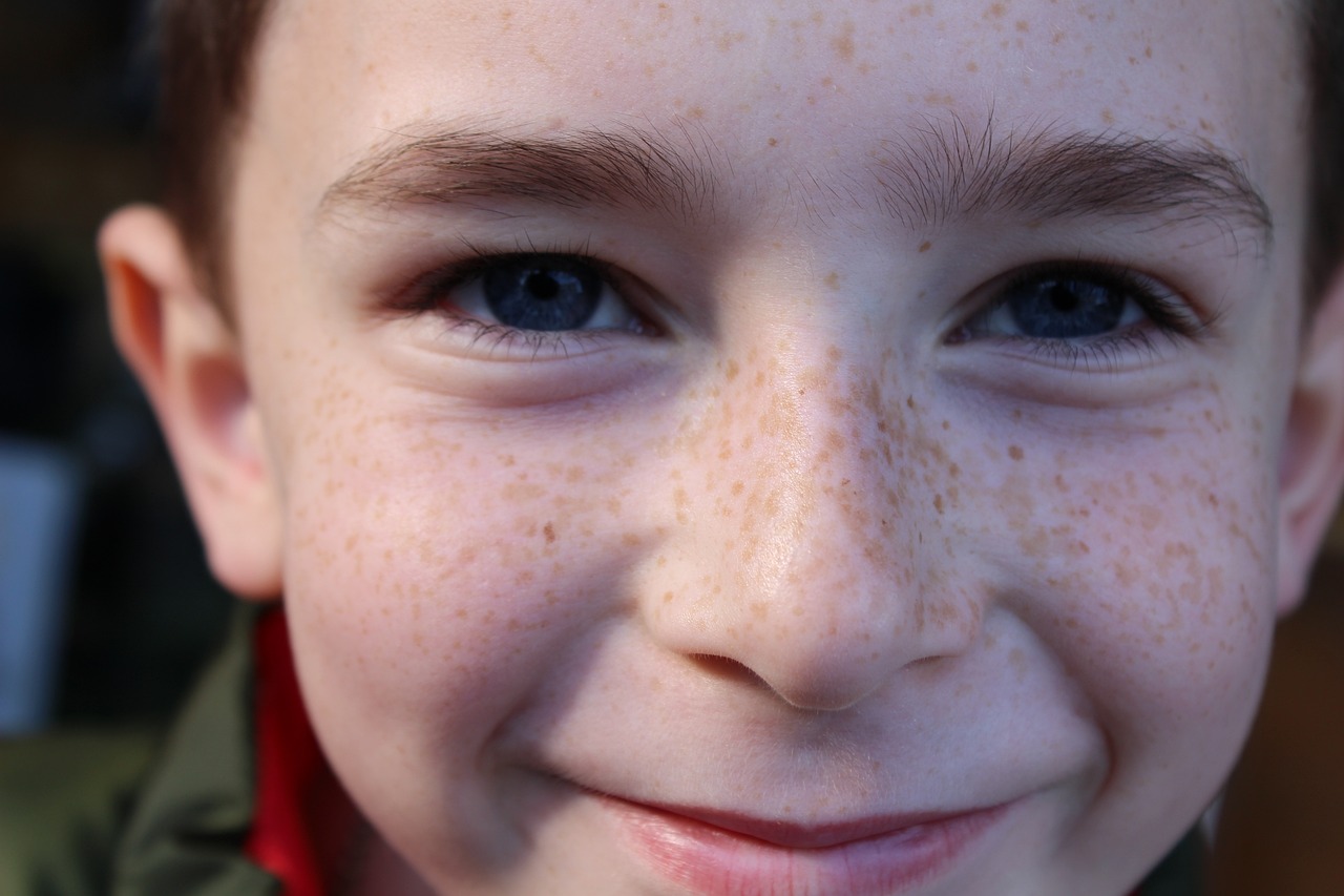 Freckles