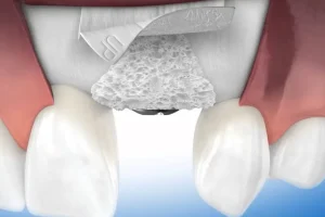 Bone Graft