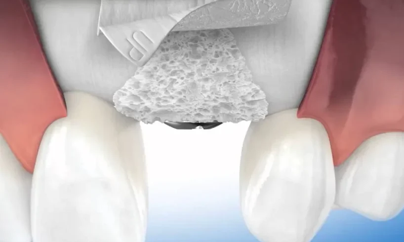 Bone Graft