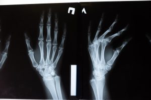 Bone graft