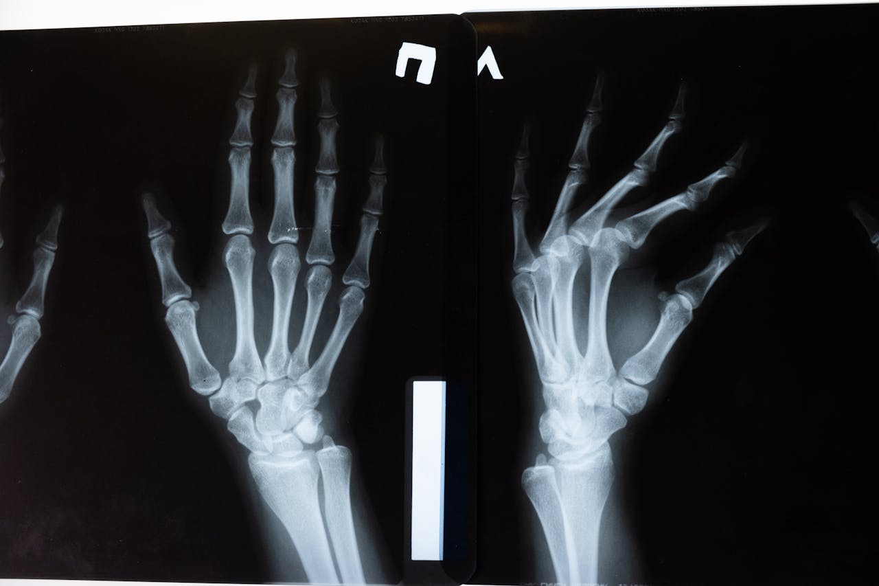 Bone graft